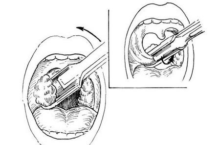 扁桃体的解剖图简笔画